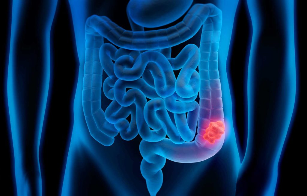 Ricerca dell’antigene fecale di Helicobacter pylori Bio Plastic on Diagnostics